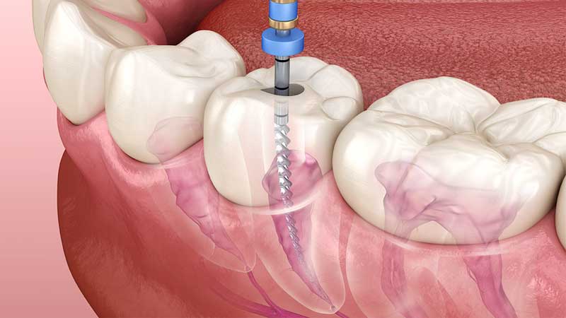 Root Canal Treatment