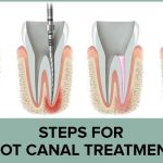 Root Canal Treatment