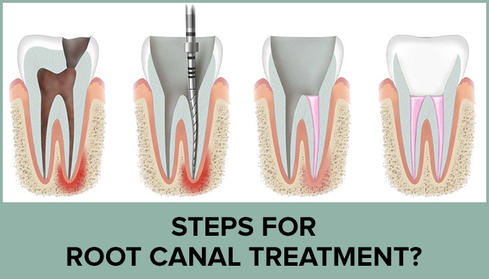 6 Root Canal Treatment Myths, Busted!