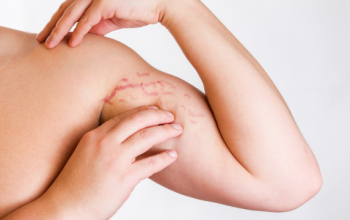 Menghilangkan Stretch Mark
